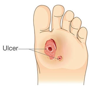 diabetic foot ulcers