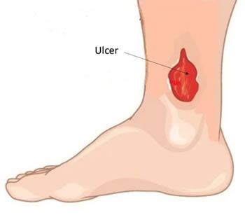 venous leg ulcers