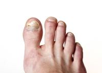 Do I Have Toenail Fungus?