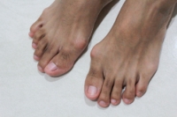 Bunion Deformities