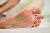 Managing Plantar Warts