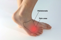 Key Facts About Morton’s Neuroma