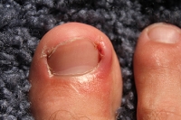 Surgery for Ingrown Toenails