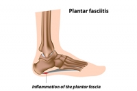 Plantar Fasciitis on the Rise During the Pandemic