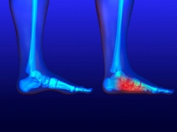 Causes of Flat Feet in Adults