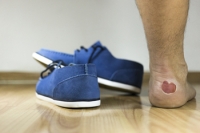 Insight into Foot Blisters